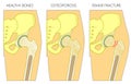 Osteoporosis1_with femur fracture and dislocation Royalty Free Stock Photo