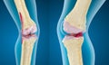 Osteoporosis of the knee joint