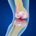 Osteoporosis of the knee joint