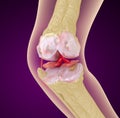 Osteoporosis of the knee joint