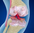 Osteoporosis of the knee joint, Medically accurate illustration