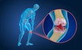 Osteoporosis of the knee joint, Medically accurate illustration