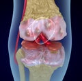 Osteoporosis of the knee joint, Medically accurate