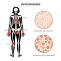 Osteoporosis medical poster Royalty Free Stock Photo