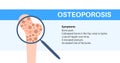 Osteoporosis medical poster
