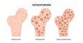 Osteoporosis medical poster Royalty Free Stock Photo