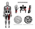 Osteoporosis medical poster Royalty Free Stock Photo