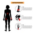 Osteoporosis medical poster