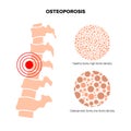 Osteoporosis medical poster