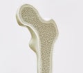 Osteoporosis stage 1 of 4 -- 3d rendering