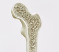 Osteoporosis stage 1 of 4 -- 3d rendering