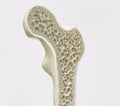 Osteoporosis stage 1 of 4 -- 3d rendering Royalty Free Stock Photo