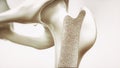 Osteoporosis stage 1 of 4 - upper limb bones - 3d rendering