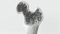 Osteoporosis stage 3 of 3 on white background -- 3d rendering