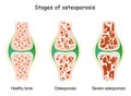 Osteoporosis stages. aging process with bone