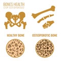 Osteoporosis Stages Image