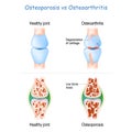 Osteoporosis vs Osteoarthritis