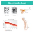 Osteoporotic bone. The old man`s health deteriorated because from the lack of calcium. Royalty Free Stock Photo