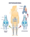 Osteosarcoma bone tumor as osteogenic sarcoma skeleton cancer outline diagram