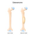 Two human bones: healthy femur and bone with osteosarcoma