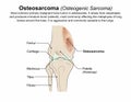 Osteosarcoma (Osteogenic Sarcoma) Royalty Free Stock Photo