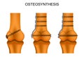 Osteosynthesis of the femur Royalty Free Stock Photo