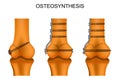 Osteosynthesis of the femur