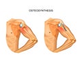 Osteosynthesis in the fracture of the humerus head