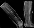 Osteosynthesis of fractured tibial bone