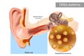 Otitis externa also called swimmer's ear. Inflammation ear canal of the Staphylococcus aureus.. Human Ear Anatomy