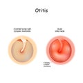 Otitis. Healthy membrane, and bulging tympanic membrane of Acute otitis media Royalty Free Stock Photo