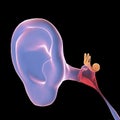 Otitis media, illustration Royalty Free Stock Photo