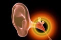 Otitis media, illustration Royalty Free Stock Photo