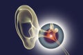 Otitis media, illustration Royalty Free Stock Photo