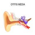 Otitis media. Human anatomy. Royalty Free Stock Photo