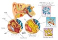 Otitis media