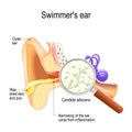 Otitis. swimmer`s ear is inflammation of the ear canal and fungal infection that caused this disease. Candida albicans Royalty Free Stock Photo