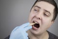 An otolaryngologist examines a man`s throat with a wooden spatula. A possible diagnosis is inflammation of the pharynx, tonsils o