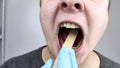 An otolaryngologist examines a man's throat with a wooden spatula. A possible diagnosis is inflammation of the pharynx, tonsils o