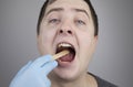 An otolaryngologist examines a man`s throat with a wooden spatula. A possible diagnosis is inflammation of the pharynx, tonsils o Royalty Free Stock Photo