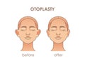 Otoplasty. Ear surgery. Vector illustration of female face before and after. Plastic surgery