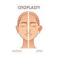 Otoplasty. Ear surgery before and after. Vector illustration of female face. Plastic surgery