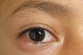 Outer view of nodule shaped style- chalazion on the lower eyelid of child. Papilledema