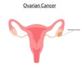 Ovarian cancer vector illustration Royalty Free Stock Photo