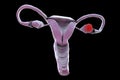 Ovarian cancer, 3D illustration