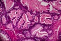 Ovarian cancer, light micrograph