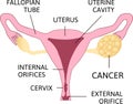 Ovarian Cancer. Ovarian carcinoma, germ cell tumor, sex cord stromal tumor
