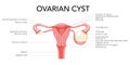 Ovarian cyst diagram Female reproductive system uterus labeled in Anatomical infographic. Front view gynecological
