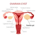 Ovarian cyst. Diseases of the female reproductive system. Gynecology. Medical concept. Infographic banner.