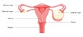 Ovarian cyst Female reproductive system uterus in Anatomical infographic diagram with inscriptions in Latin text. Human